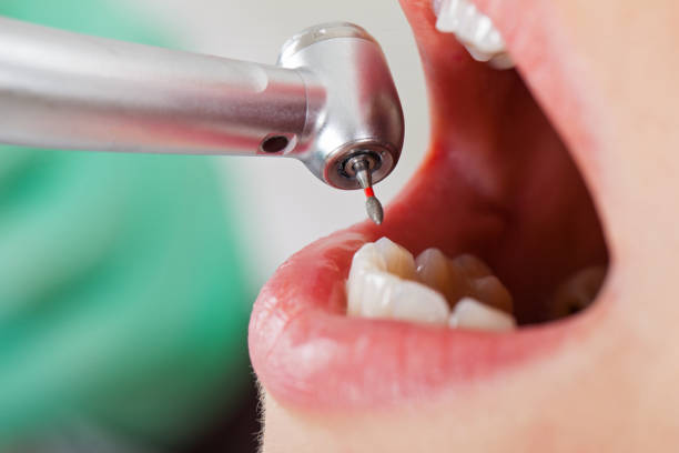 Best Emergency Wisdom Teeth Removal in Macon, MO